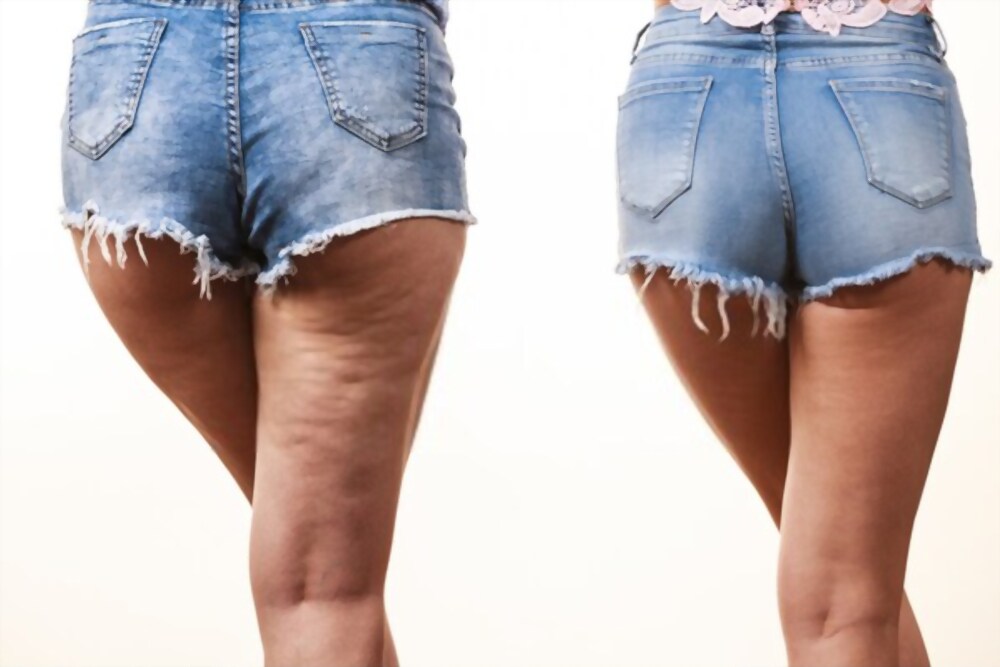 rassodare gambe e glutei