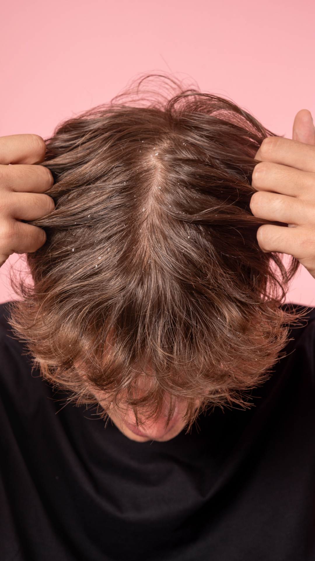 Ragazzo con capelli castani che sposta dolcemente i ciuffi di capelli posizionati al centro della testa per mostrare la cute piena di Forfora