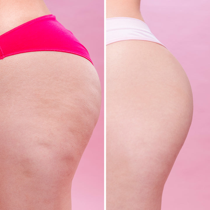 Cellulite Remover - Crema Anticellulite | Eco Bio Boutique