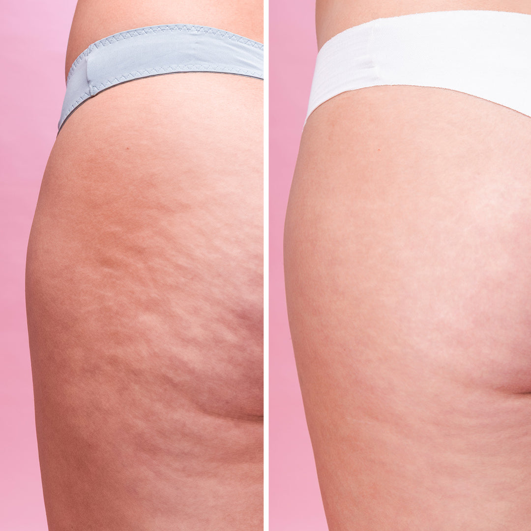 Cellulite Scrub