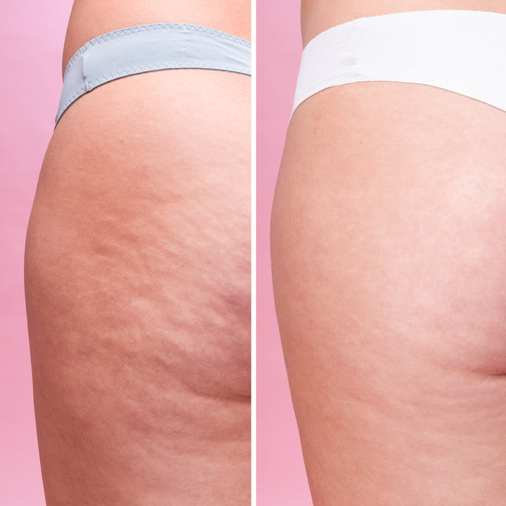 Cellulite Scrub